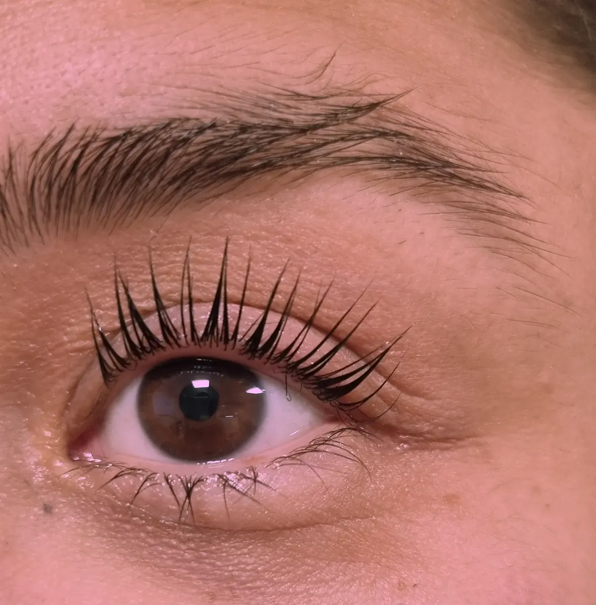 Gelifteter Wimpernkranz am Unterlid